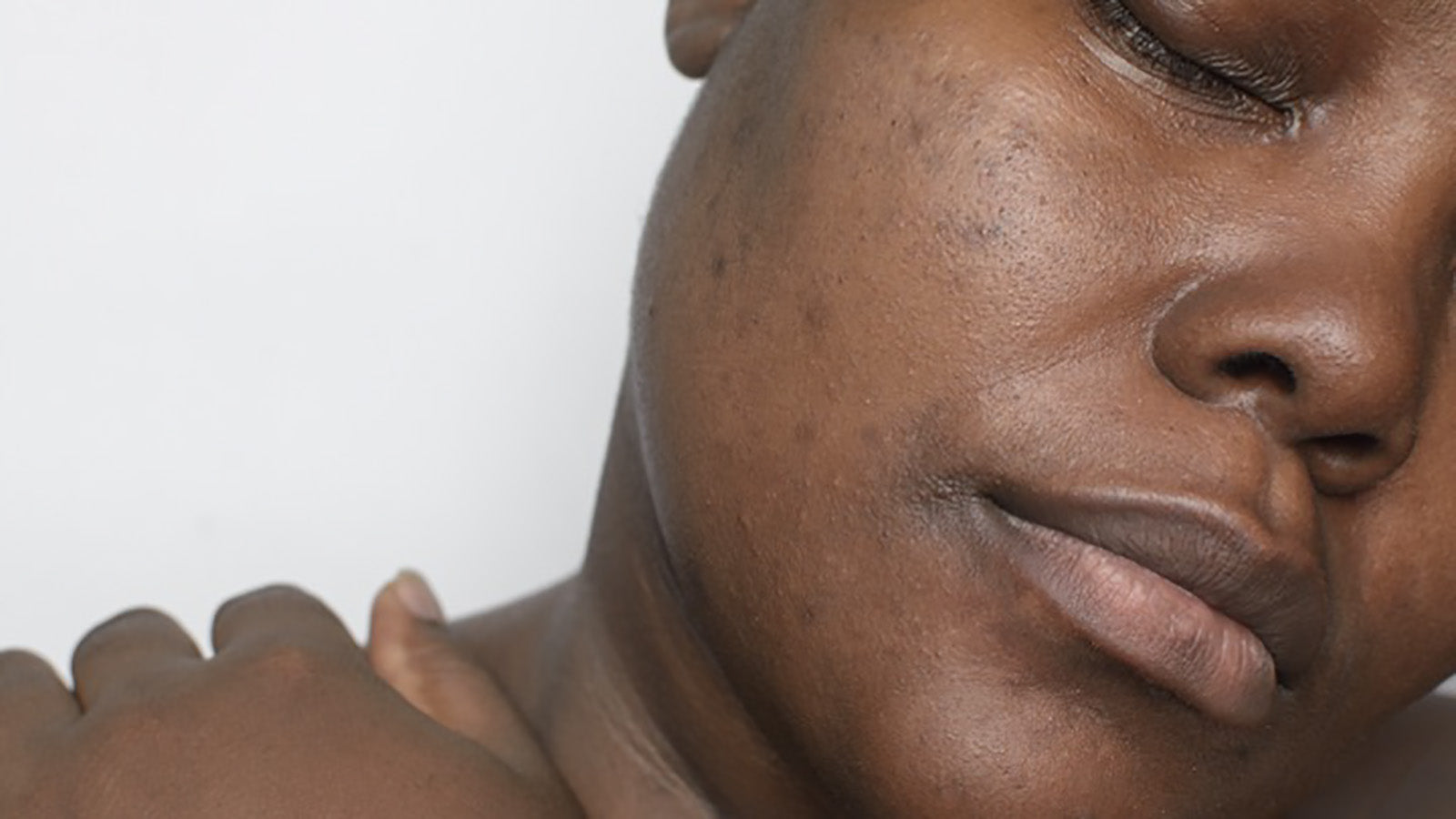 Say Goodbye to Dark Spots: Niacinamide Serum for Clearer Skin
